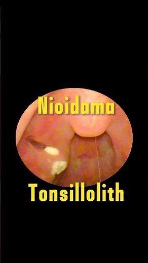 Tonsil Stone Removal - Dr Tuan ENT