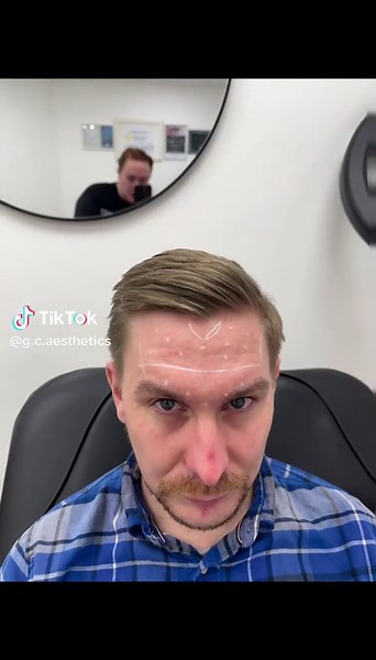 The Importance of Facial Mapping Before Botox Treatment