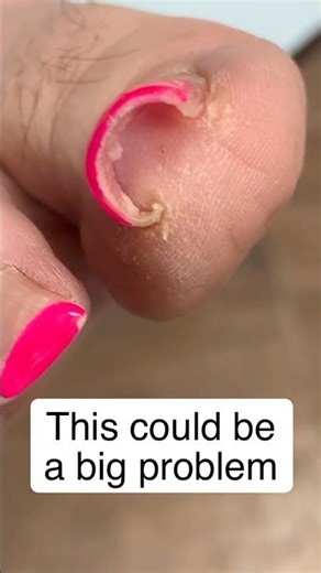 This nail was curving into the skin… watch this