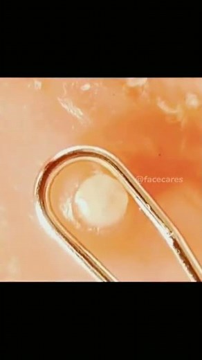 Best new pimple popping, cyst and blackhead extraction videos 2022 || Pimple time #14