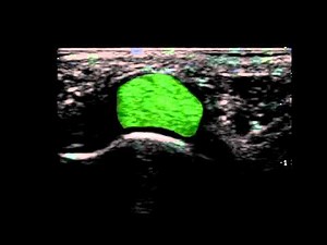 Musculoskeletal Ultrasound: Hand 9: palmar transverse scan of MCP joint