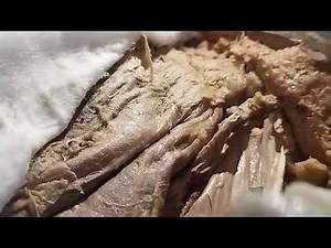 Inguinal canal-Dissection in Female. by. Dr. Veeramalla.