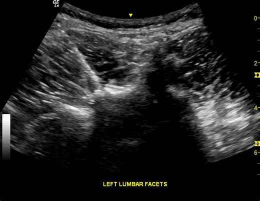 US guided injection to the left L3/4 facet joint and capsule. Needle = 22g x 100 mm standard hypodermic. Needle approach is in-plane from lateral to medial The advantages of this approach are: - you can get the facet joint/capsule - you can do a traditional medial branch block - you can get the medial, intermediate, and lateral branches over the transverse process - you can get the insertion of the quadratus lumborum on the TVP - you can get the multifidus - you can get the lateral aspect of the