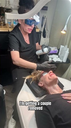 Sunspot & Sun damaged Skin Laser Treatment NOUVADerm Laser! The best laser treatment in Phoenix
