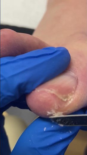 Banish Painful Nail Calluses - Learn How to Treat and Prevent Now! #NailCare #HealthyFeet