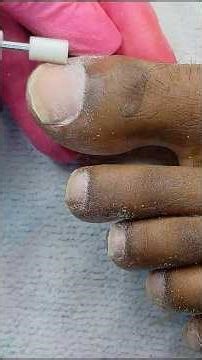 "Fix Thick & Damaged Toenails FAST! 🦶✨ | Ultimate Toenail Cleaning Tutorial"