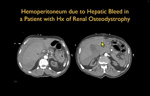 Hemoperitoneum due to Hepatic Bleed in a Patient with Hx of Renal Osteodystrophy View the images here: https://www.ctisus.com/teachingfiles/cases/liver/415079 | CTisus: Cutting edge information on body CT (Computed tomography).