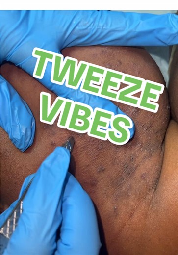 PCOS/Hirsutism face tweezing (Part 2) Remember to not shave your face or put hair removal creams on it. Find a healthier way to extract your hair, especially when it comes to the face. #fyp #wax #waxing #foryoupage #pcos