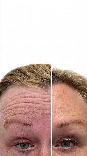 Forehead Wrinkle Treatment - Before & After