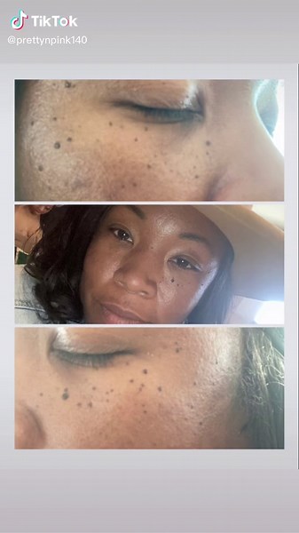 Effective Skin Formula Treatment for Moles on Black Skin