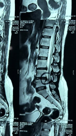 Interlaminar Uniportal Endoscopic for Bilateral Foraminal Stenosis and Degenerative Disk