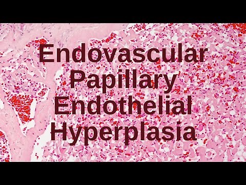 Endovascular Papillary Endothelial Hyperplasia - Pathology mini tutorial