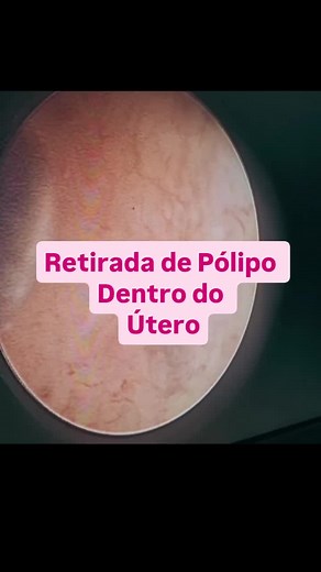 Pólipo Intrauterino: Remoção e Histeroscopia Explicada