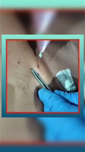 Laser Wart Removal | Painless & Quick Treatment