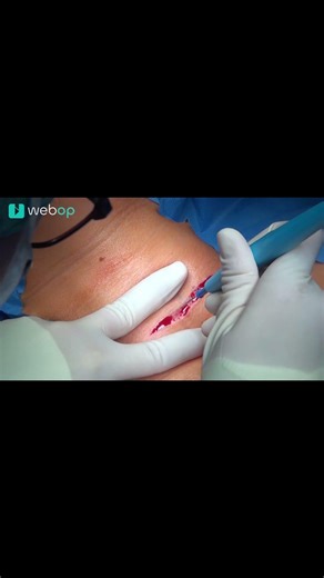 Tiroidectomía total por bocio nodular benigno bilateral. | Cierre de la herida | Incisión c #Shorts