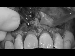 The apicectomy: Root resection after root canal treatment