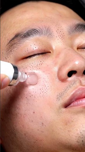 Insane Blackhead Extraction Close-Up