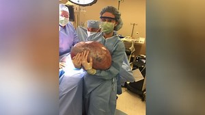 Doctors remove 50 pound ovarian cyst from woman's body