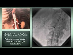 Thoracoabdominal aortic aneurysm: a totally endovascular approach with a branched stent-graft