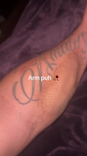 Understanding Compartment Syndrome After Gunshot Injuries