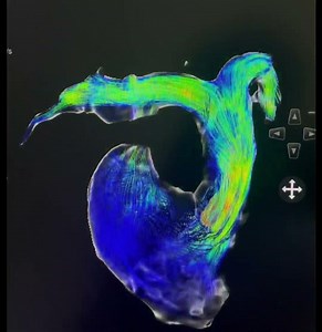 4D Flow MRI of the Pulmonary Arteries