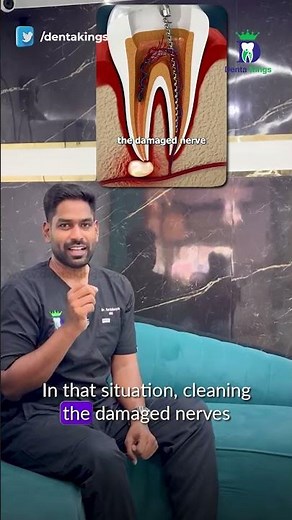 வேர் சிகிச்சை என்றால் என்ன? - What is root canal treatment | Dr.karthikeyan | Denta Kings