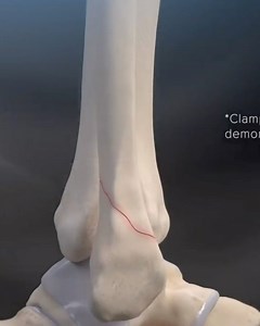 33K views · 161 reactions | Storm confirm Ryan Papenhuyzen suffered a small fracture in his fibula (outer shin bone), the same bone he fractured late last year. Surgery is likely to be required and they expect him to miss between 4-6 weeks at this stage. | NRL Physio | Facebook