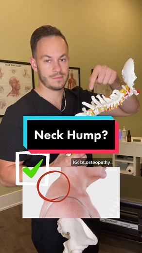 Ways to Fix Neck Hump - Relieve Pain with Easy Exercises