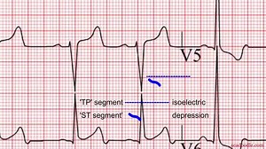 Bite-sized medical tutorial videos created by experts in the field. Become an ECG guru! Learn more: http://bit.ly/2xxtVrK | Acadoodle