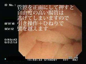 大腸内視鏡検査 TypeC No.4 Colonoscopy