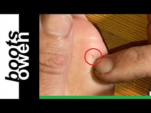 Easy way to remove a small splinter in a child's hand with a pin | no pain | try this 1 simple trick