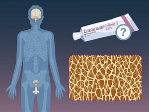 Testosterone Treatment and Fractures in Hypogonadism | NEJM