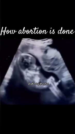 How Abortion Is Done? Abortion on Realtime Ultrasound