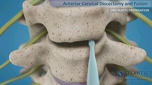 颈椎病手术治疗（ACDF）动画演示