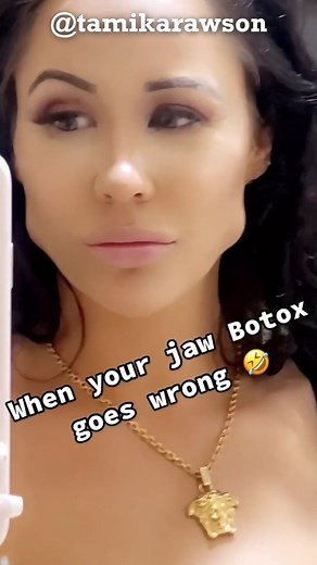 224K views · 280 reactions | Masseter botox gone wrong | Dr Tim Pearce | Facebook