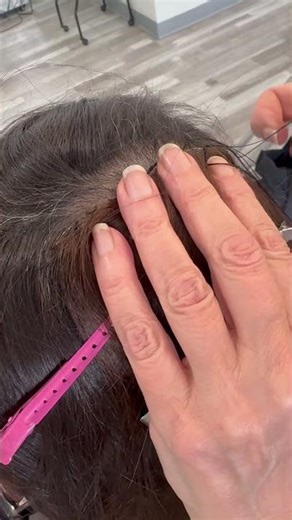 Custom Mesh Integration for Trichotillomania Hair Loss | Natural Crown Restoration