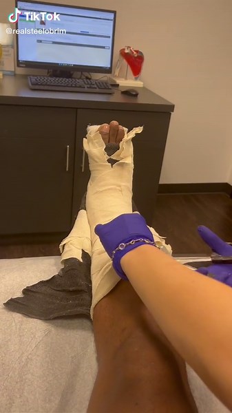 Got the swelling down. But a month away from getting out of this hard cast. Pt1 #steelobrim #anklebreaker #roadtorecovery #Vecna #L