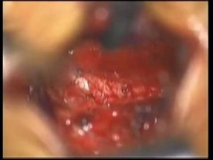 Microdiscectomy in the Lumbar Region • Video • MEDtube.net