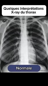 🚨Quelques interprétations de la radiographie du thorax. | Coin Santé plus