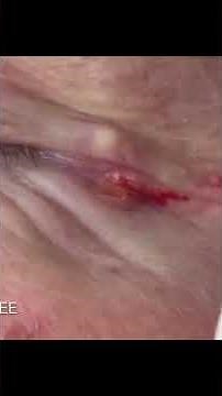 Blackheads Around the Eyes