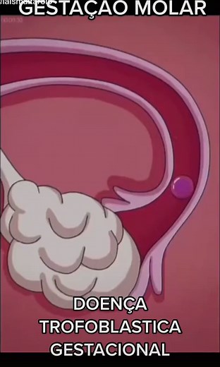Gravidez Molar: Tipos, Sintomas e Desenvolvimento
