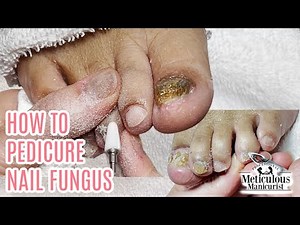 How to do a Pedicure on a Bad Case of Nail Fungus transformation