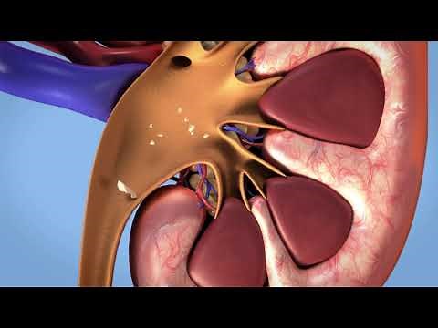 Litotripsia Extracorporea