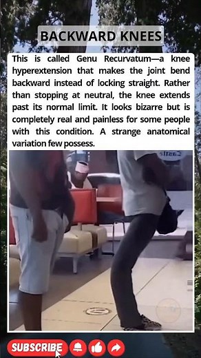 The Rare Condition That Makes Knees Bend BACKWARD.😯