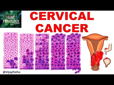 Squamous Intraepithelial lesion & CANCER CERVIX