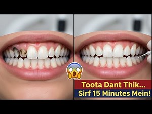 Composite Restoration Explained | How Dentist Fixed a Broken Front Tooth