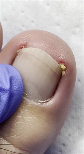 Satisfying nail cleaning process 😍 The transformation is so smooth! Wait for the clean finish ✨ #nailcare #pedicure #satisfying #nailtech #footcare