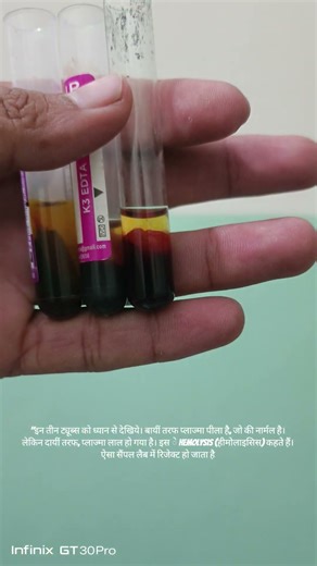 CBC sample tube "plasma hemolysis"