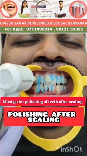 Importance of Polishing After Scaling🦷 Scaling ke baad Polishing ka importance