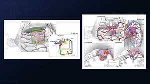 #105: Temporal Craniotomy and Subtemporal Approach for Resection of a Previously Ruptured Basal Temporal Arteriovenous Malformation - Arteriovenous Malformation - Seven Series Collection